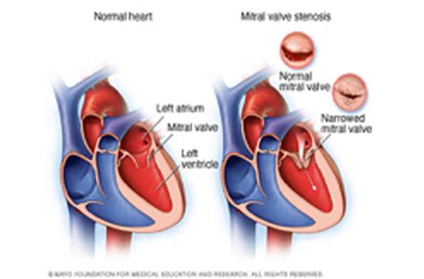 Common Health Issues Tricuspid Stenosis